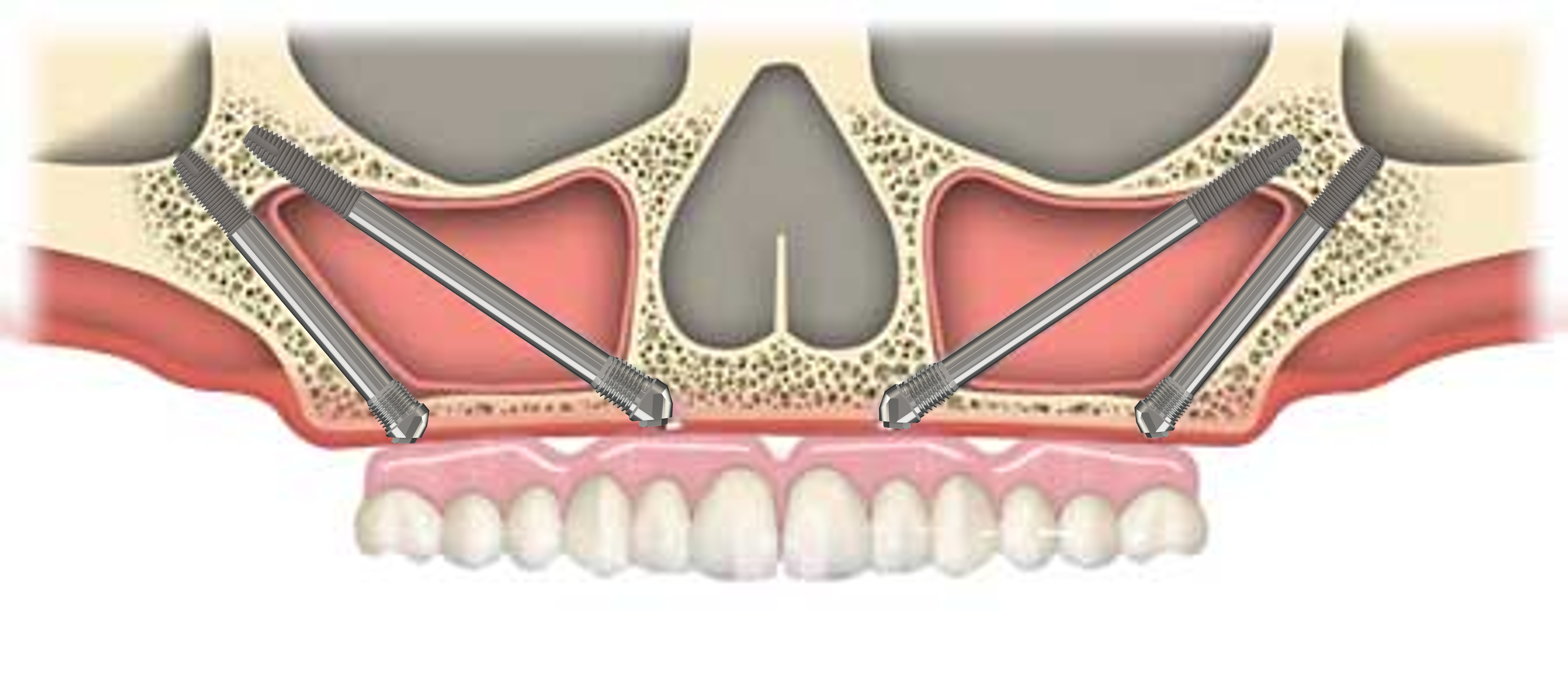 Implantes cigomáticos en maxilar atrófico severo: configuración bicigomática bilateral con anclaje extramaxilar en hueso cigomático