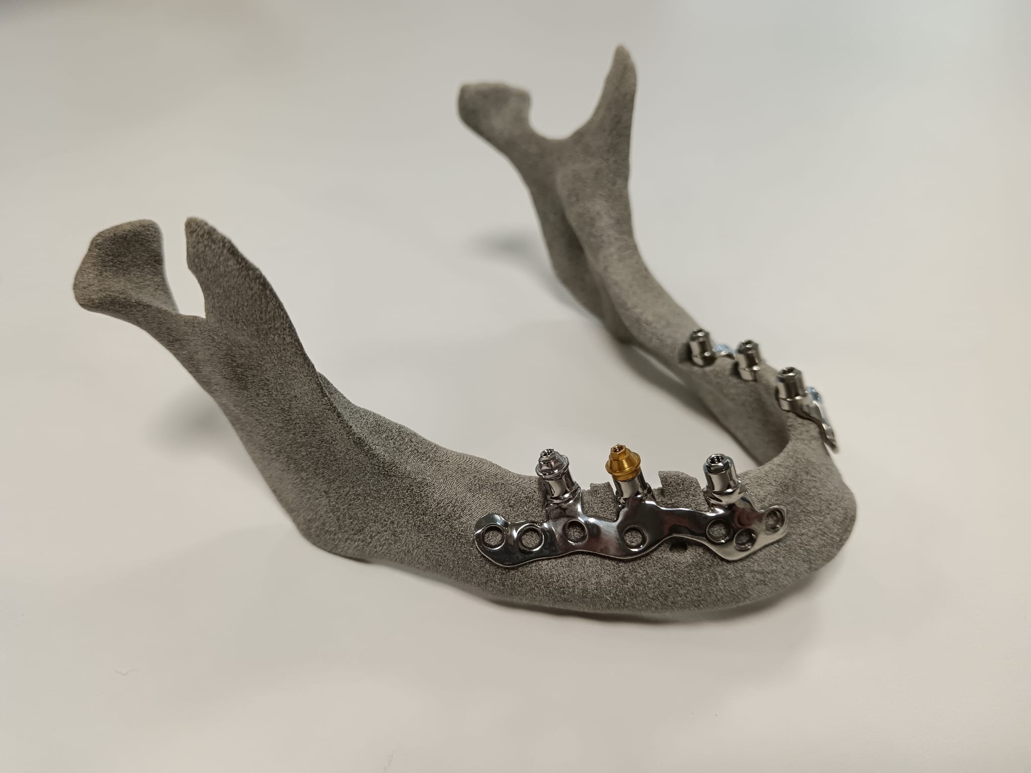 Modelo 3D de implante dental subperióstico personalizado