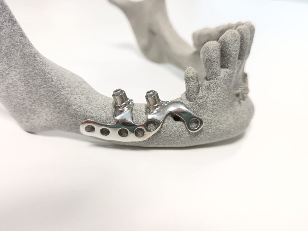 Implantes subperiósticos de titanio grado 23 diseñados a medida para pacientes con pérdida ósea severa, mostrando su estructura ligera y biocompatible lista para soportar una prótesis dental fija.