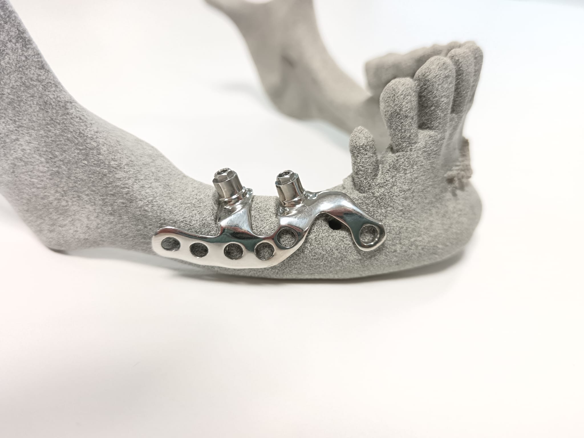 Implantes subperiósticos de titanio grado 23 diseñados a medida para pacientes con pérdida ósea severa, mostrando su estructura ligera y biocompatible lista para soportar una prótesis dental fija.