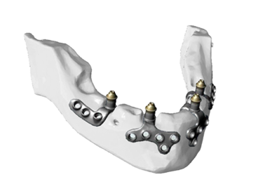 Implantes Subperi sticos Southern Implants Ib rica